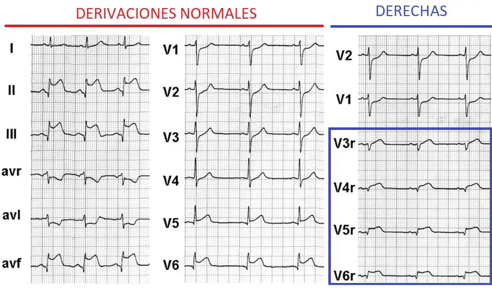  Qu Es V3 En Un Electrocardiograma Haras Dadinco